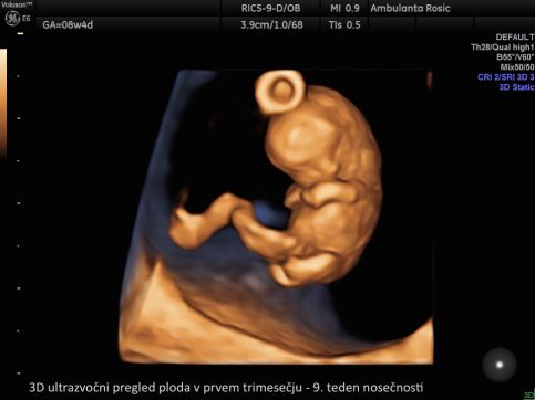 3D ultrazvocni pregled