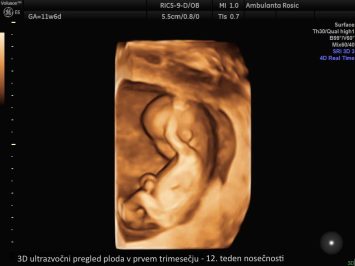 3D ultrazvocni pregled