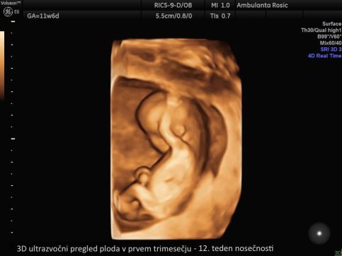 3D ultrazvocni pregled