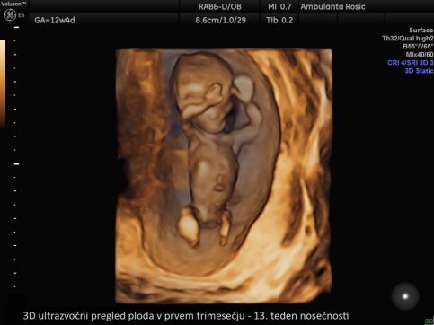 3D ultrazvocni pregled