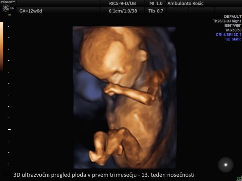 3D ultrazvocni pregled