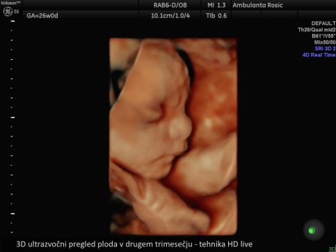 3D ultrazvocni pregled
