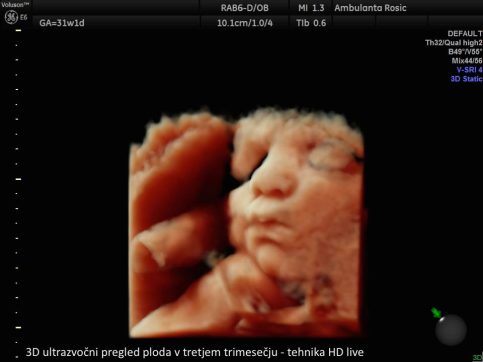 3D ultrazvocni pregled