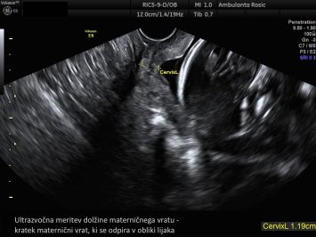 Ultrazvocna meritev maternicnega vratu